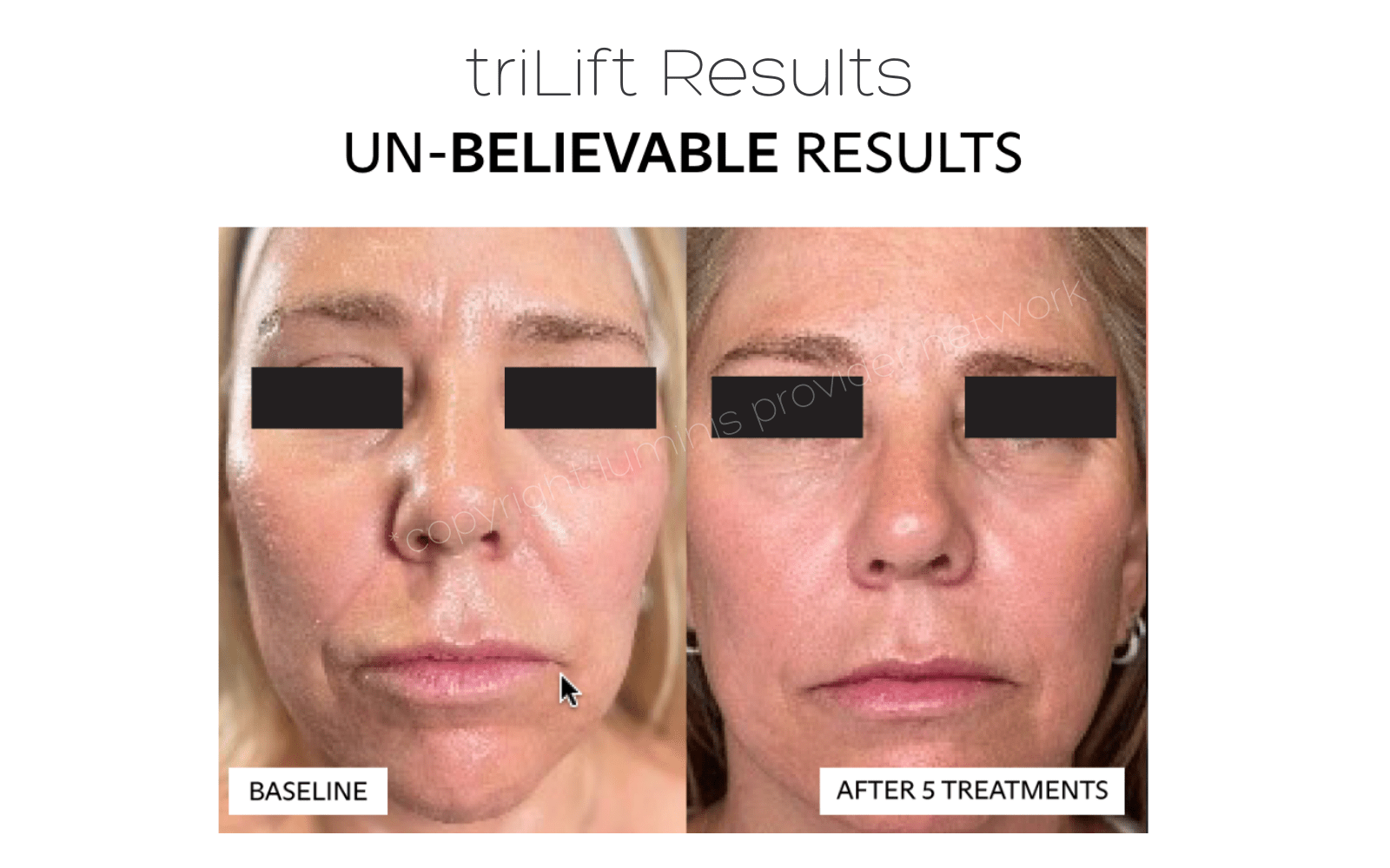 triLift results before and after 5 treatments for facial sagging - Lumenis Provider Network.