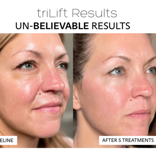 triLift results before and after 3 treatments for facial sagging