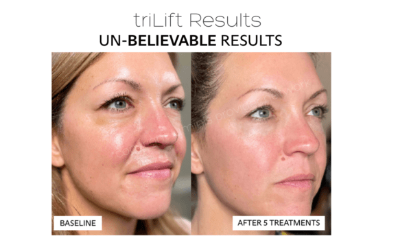 triLift results before and after 3 treatments for facial sagging