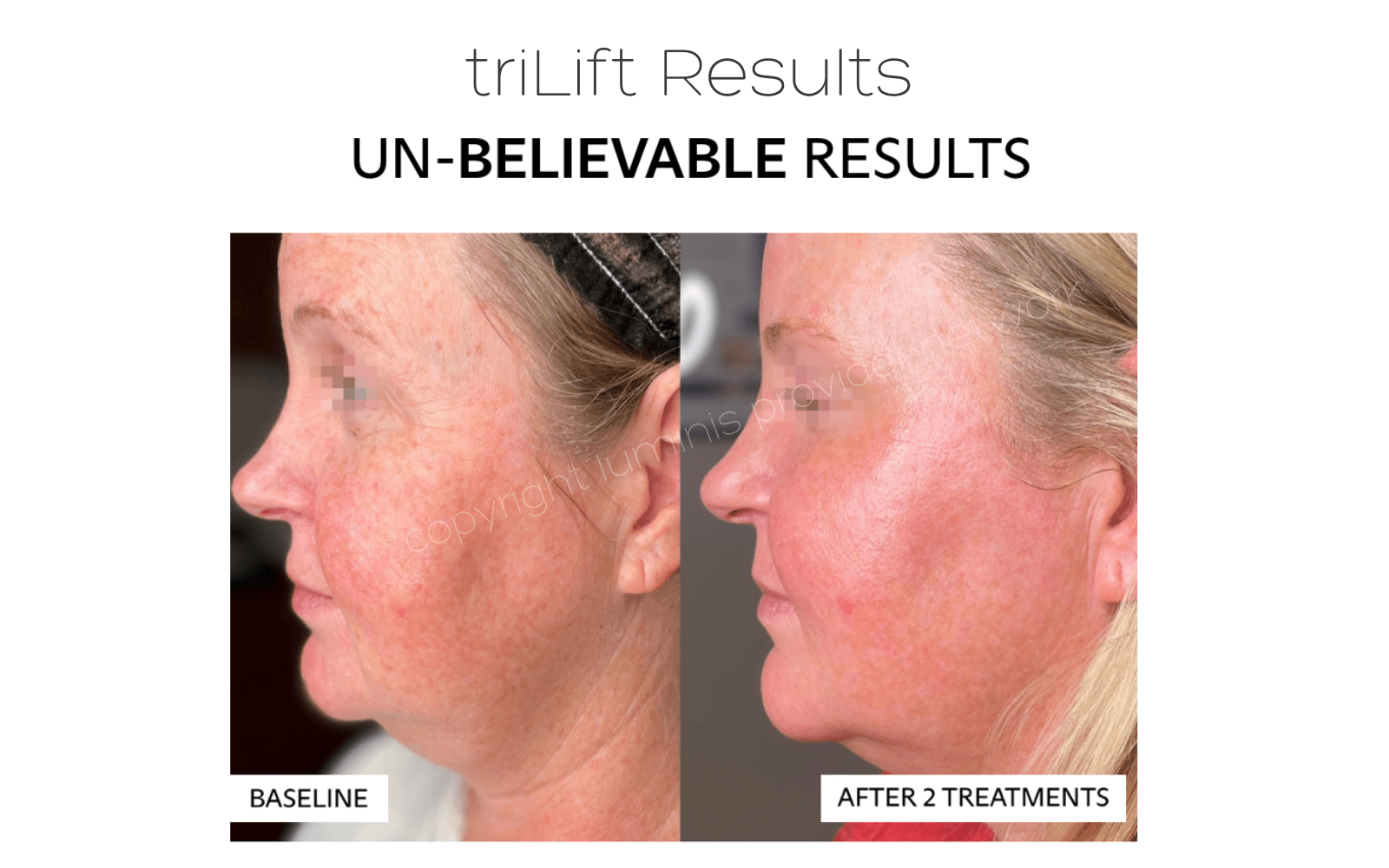 triLift results before and after 2 treatments for facial sagging