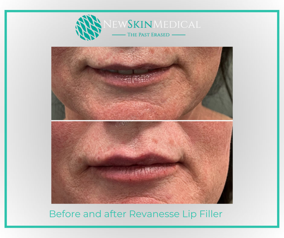 Before and after Revanesse Lip filler