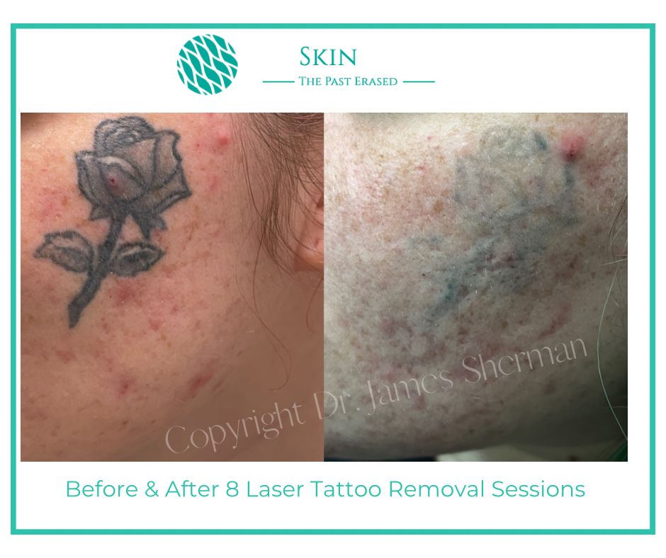 Before and After Laser Tattoo removal By Dr Sherman at New Skin Medical Spa