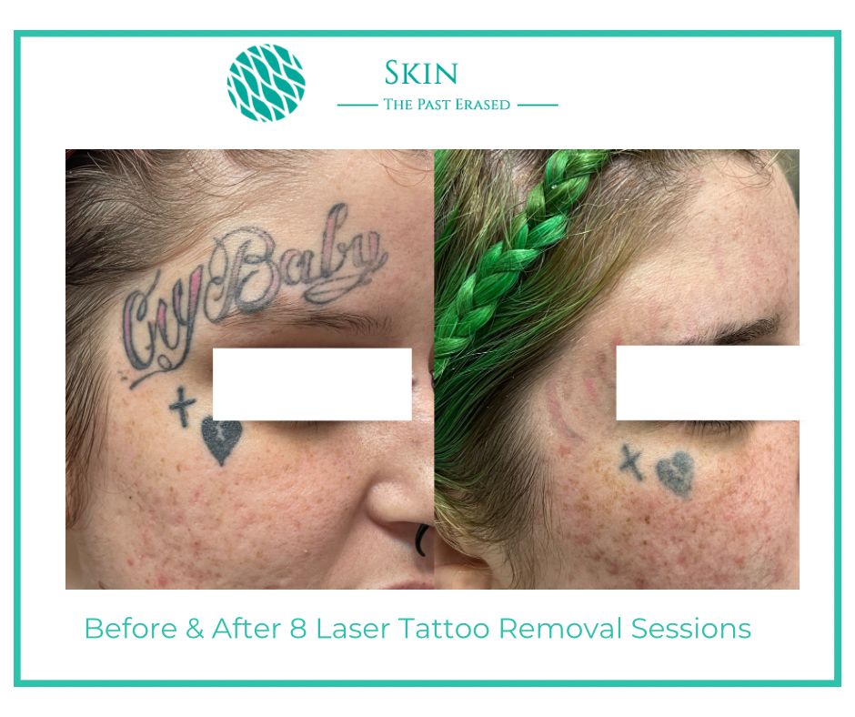 Before and after 8 Months of Laser Tattoo removal Amazing results