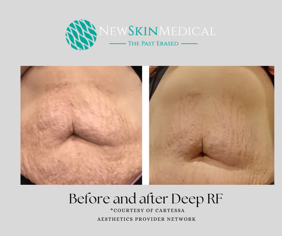 Before and After Deep RF Results at New Skin Medical Spa
