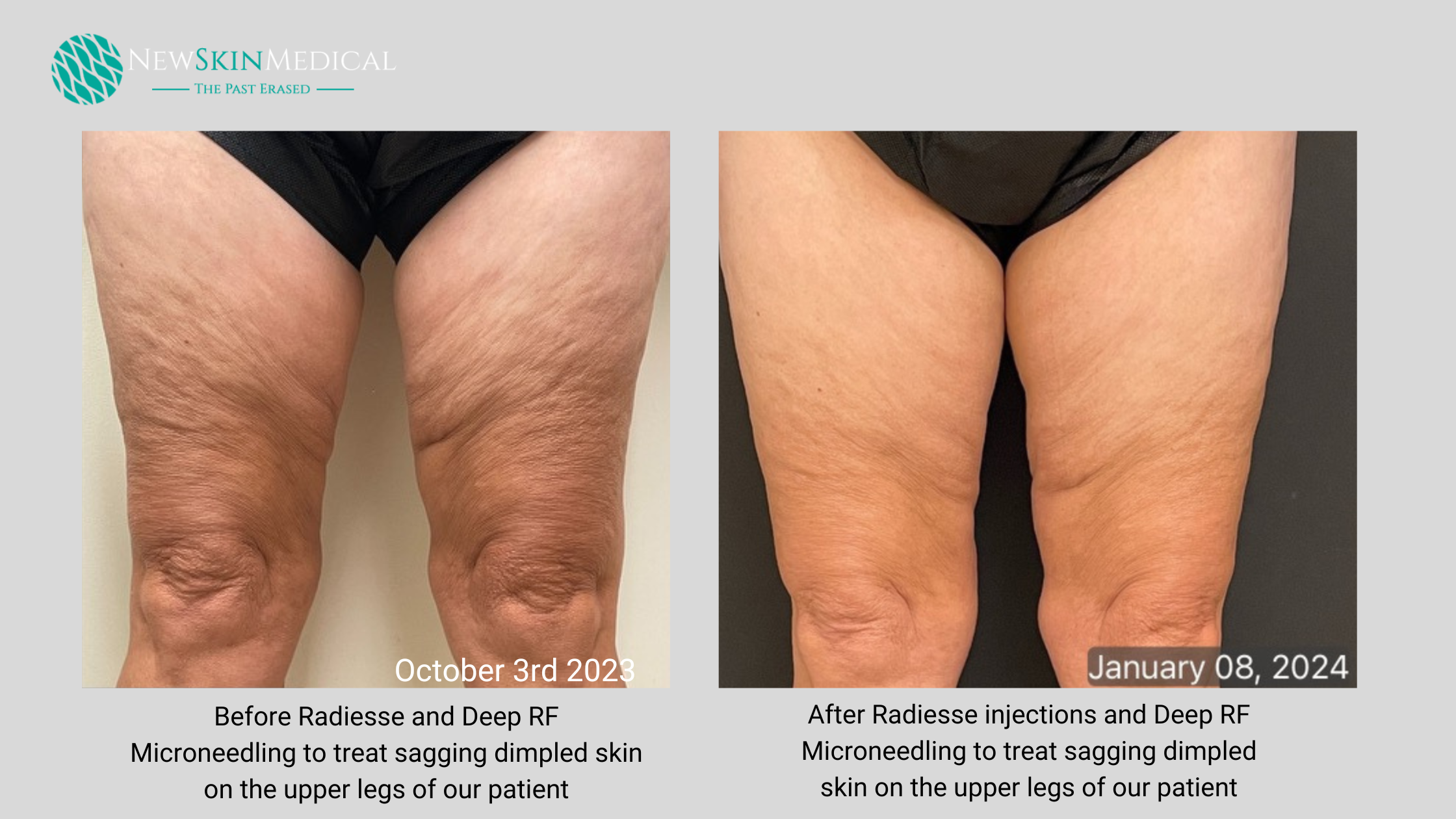 Before-and-after-deep-rf-microneedling-and-hyper-diluted-radiuses-for-sagging-legs at new skin medical spa