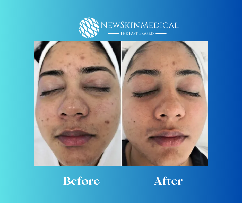 Before and After Aquafirme XS at New Skin Medical Spa