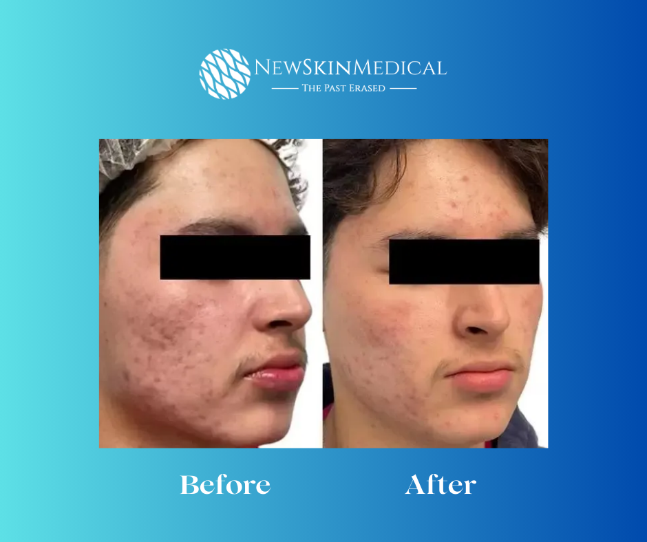 Before and After Aquafirme XS at New Skin Medical Spa