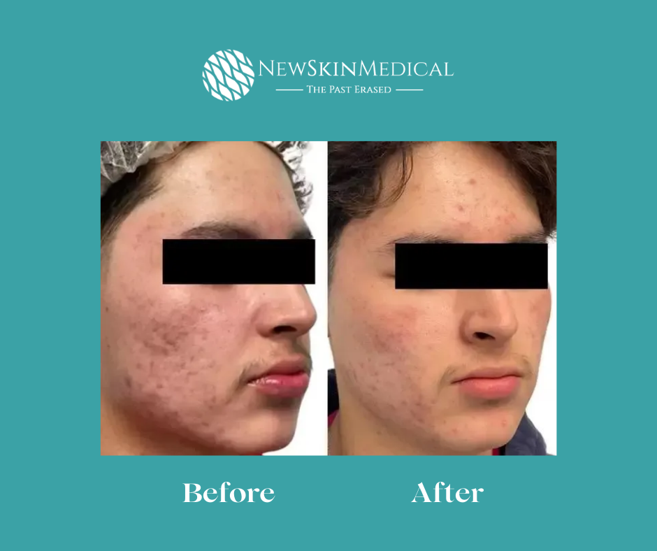 Before and After amazing results for Aquafirme Xs at New Skin Medical Spa