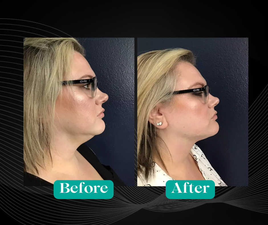 Before and After Double Chin Removal by Agnes RF