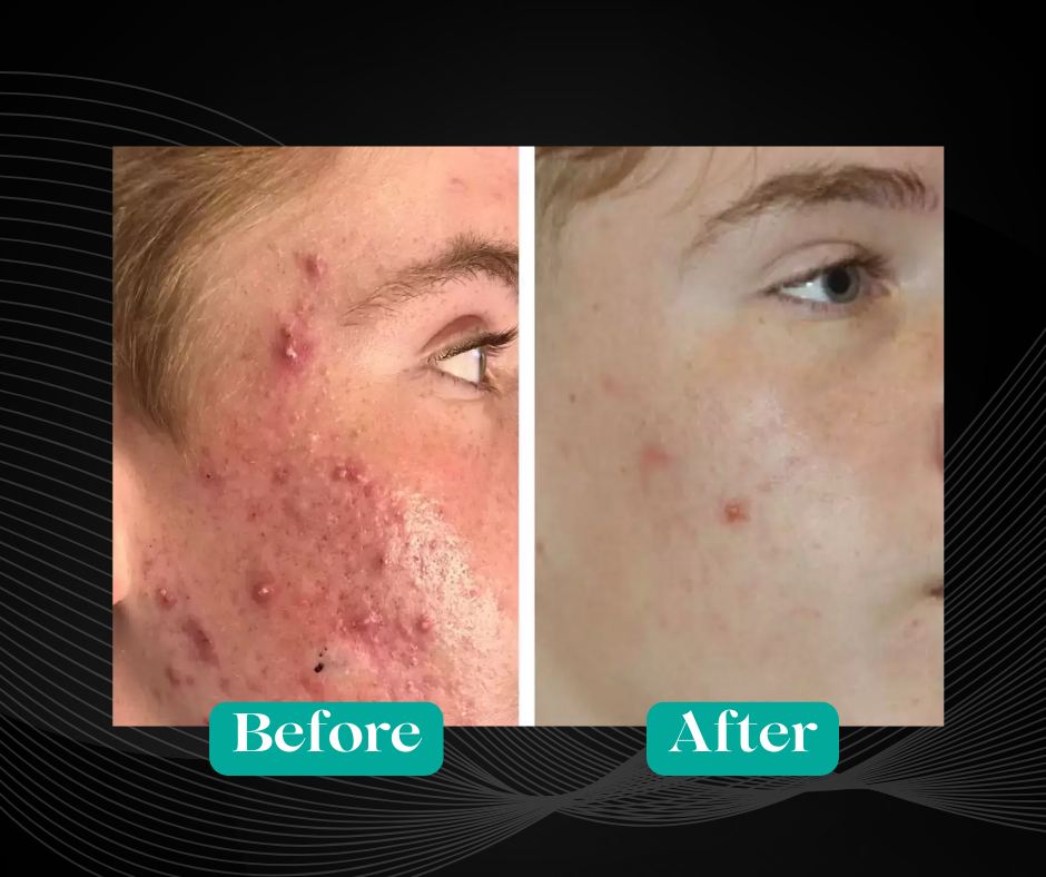 Before and After Acne Removal by Agnes RF