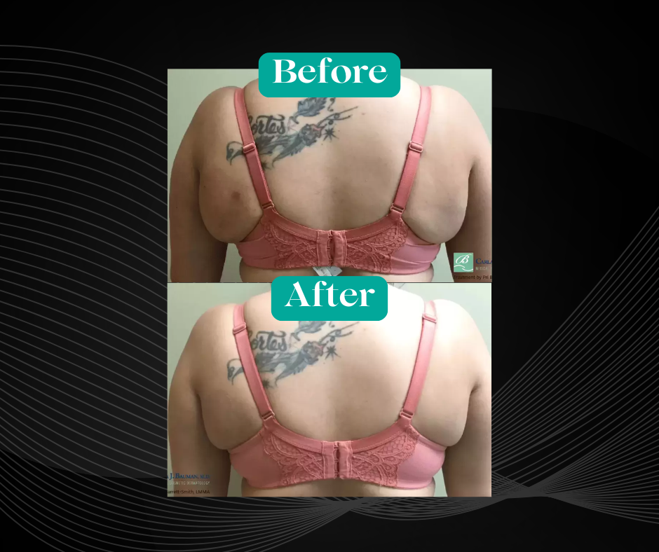 Before and After Excessive Bra Fat Removal by Agnes RF