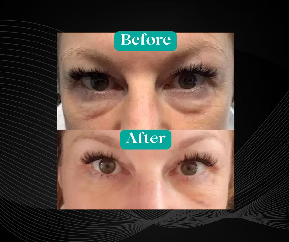 Before and After Under Eye Bag Removal by Agnes RF