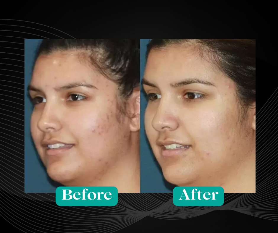 Before and After Acne Removal by Agnes RF