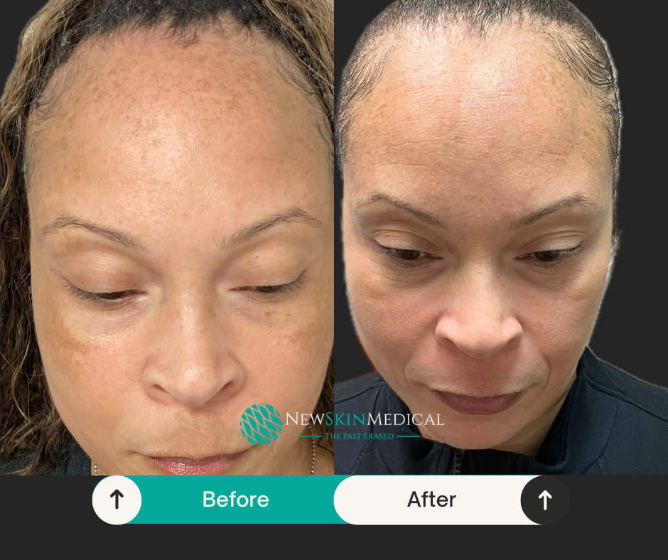 Before and After Discover Pico Laser a New Skin Medical Spa