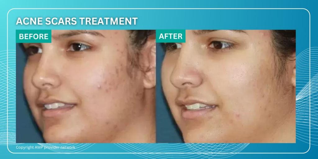 Before and After Acne Scars treatment using Agnes RF Microneedling at New Skin Medical Spa