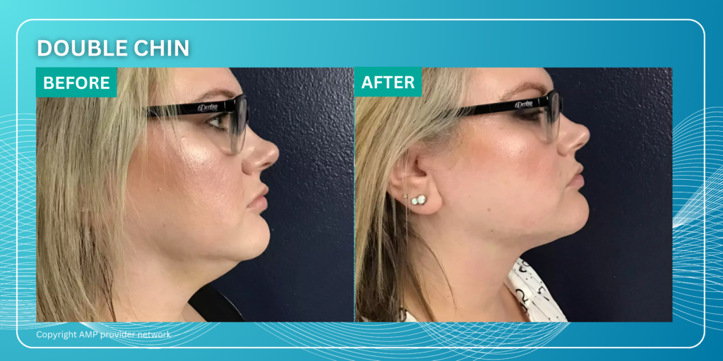 Double Chin treatment by Agnes RF Microneedling in Augusta GA