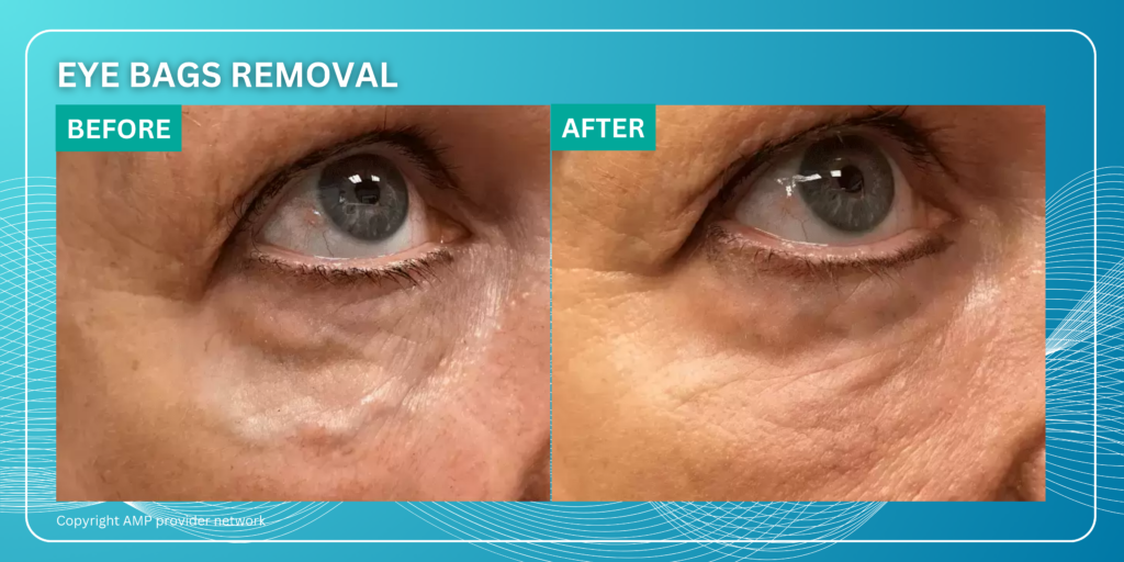 Before and After Eye bag removal using Agnes RF Microneedling at New Skin Medical Spa