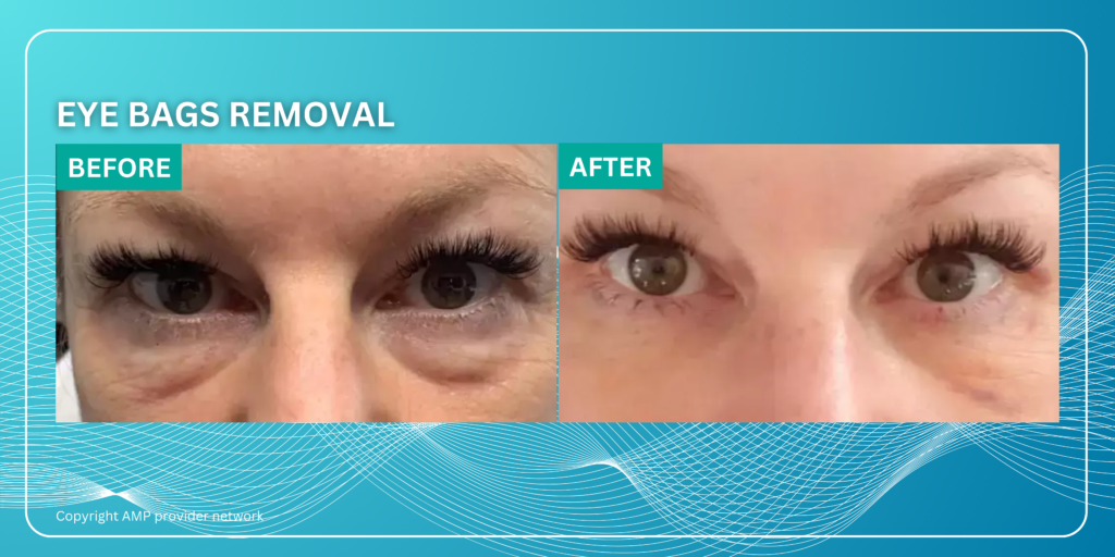 Eye Bag removal by Agnes RF at New Skin Medical Spa