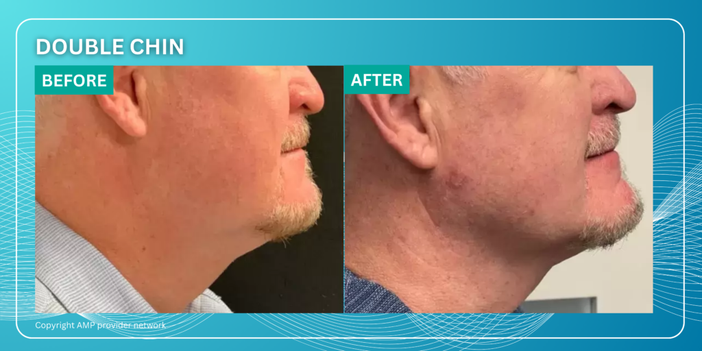 Before and After Double chin removal by Agnes RF Microneedling