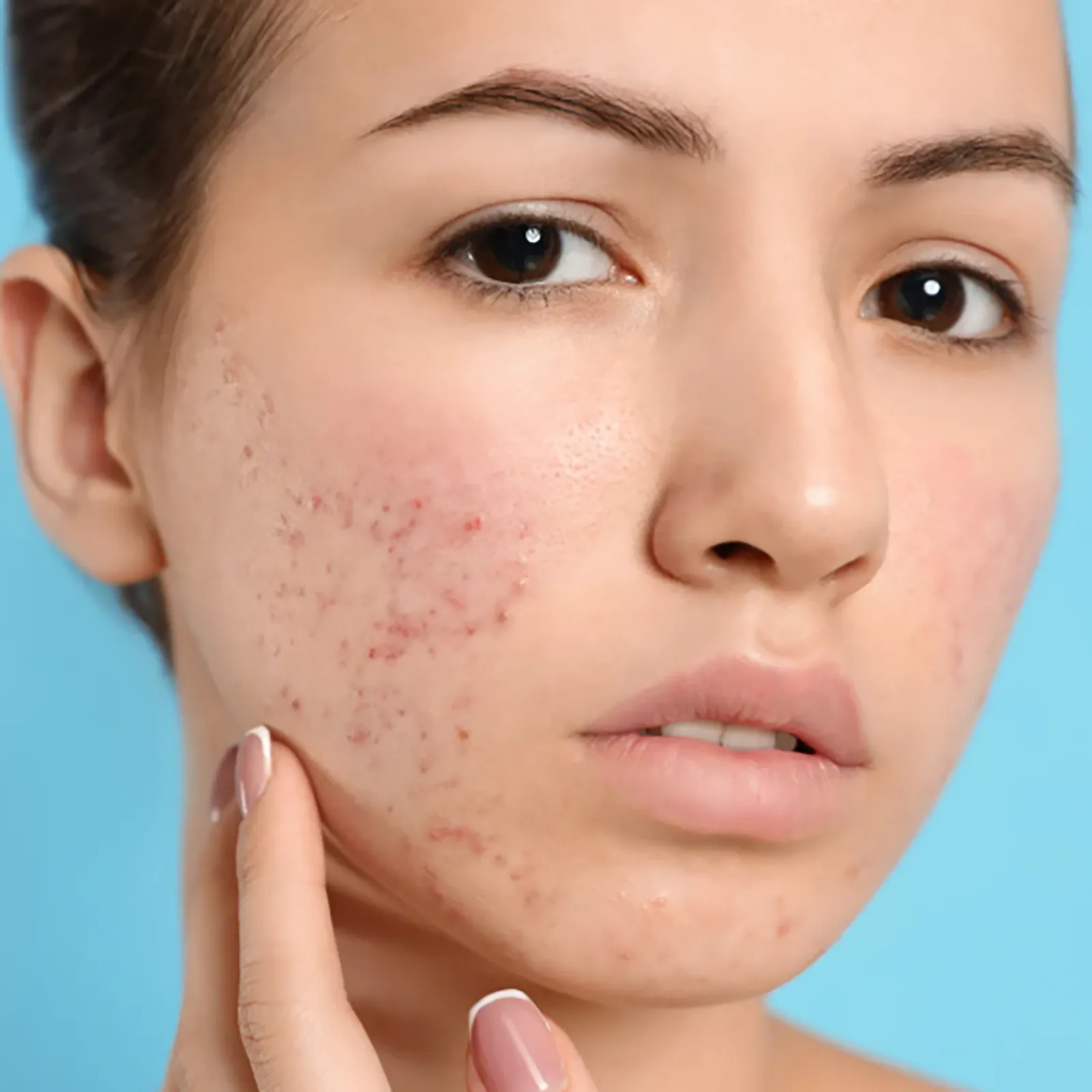 Young woman with uneven skin texture on cheek showing laser treatment candidate