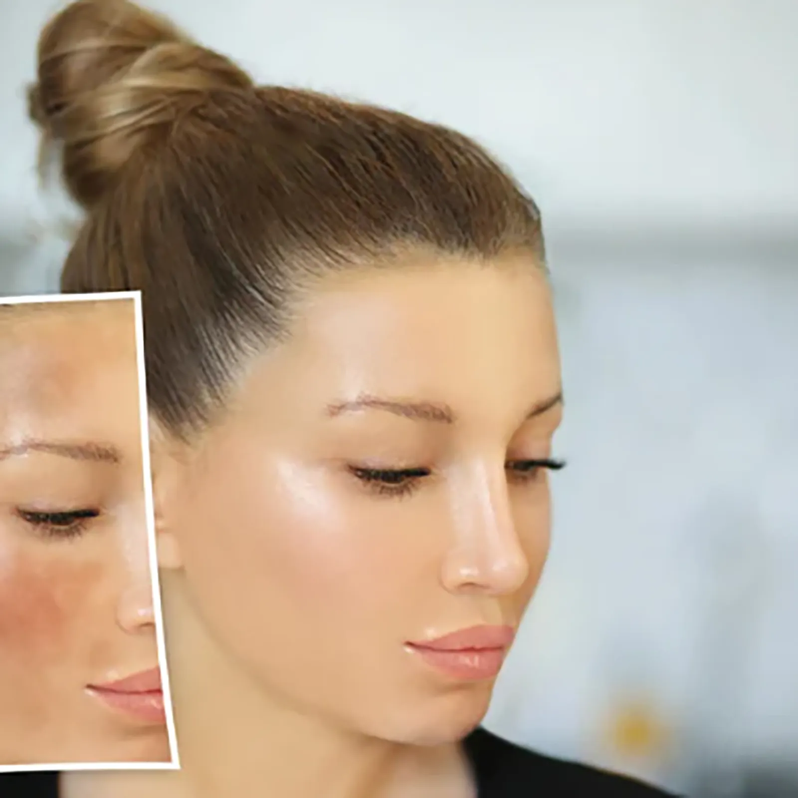 Before-and-after comparison of facial skin undergoing laser treatment